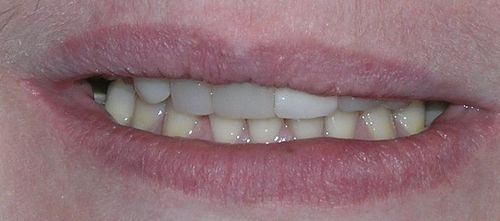 Close-up of a person's mouth, slightly open, revealing teeth. The lips are reddish-pink.