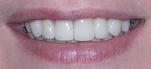 Close-up of a smiling mouth with bright white teeth. Lips are a natural pink color.