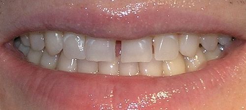 Close-up of teeth, with a gap between the two front teeth, smiling with lips slightly open.
