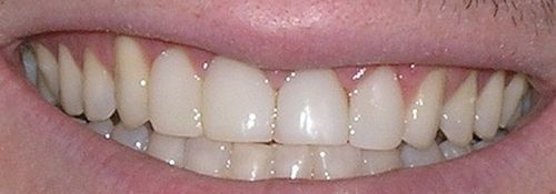 Close-up of a person's smiling mouth, showing white teeth against pink gums and lips.