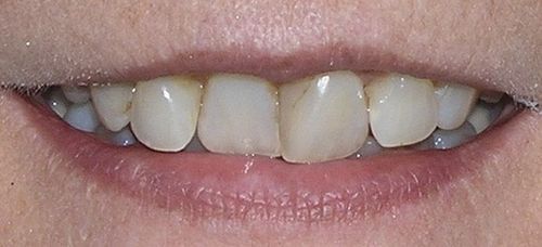 Close-up of a smiling person's teeth and lips. The teeth are white and evenly spaced. The lips are pink.