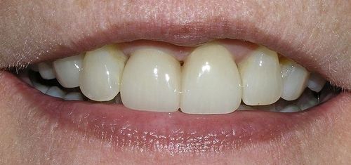 Close-up of a person's teeth and mouth; teeth are bright and even.