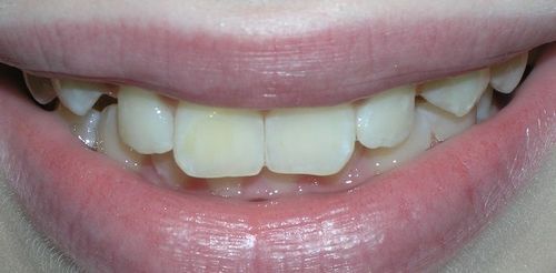 Close-up of a person's teeth showing crowding, with a slight gap between the front teeth. Light yellowish color.