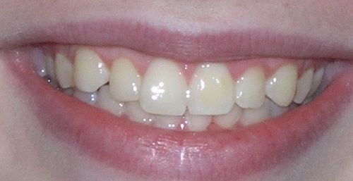 Close-up of a person smiling, showing teeth; lips are pink, teeth are off-white.