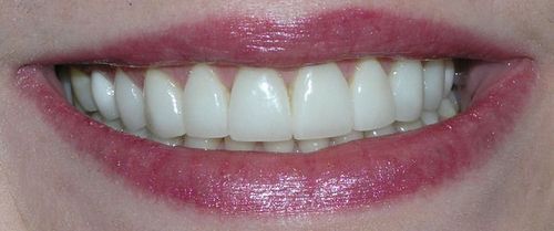 A person smiling, showing a full set of very white, evenly-shaped teeth, and glossy pink lips.