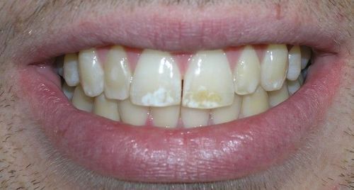 Close-up of a person's teeth, showing yellowing and white spots. The lips are visible and slightly parted in a smile.
