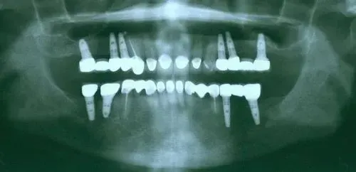 Dental X-ray of a person's teeth, showing implants. The teeth are bright white against a grey background.