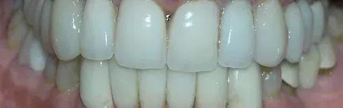 Close-up of a set of very white teeth. The teeth appear to be shiny and healthy.