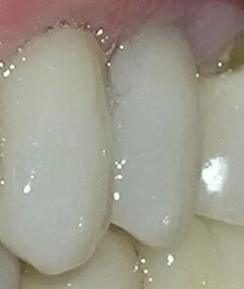 Close-up of two front teeth, white and smooth, with saliva and a bit of the gum visible.