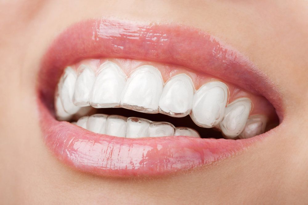 A close up of a woman 's mouth with white teeth.