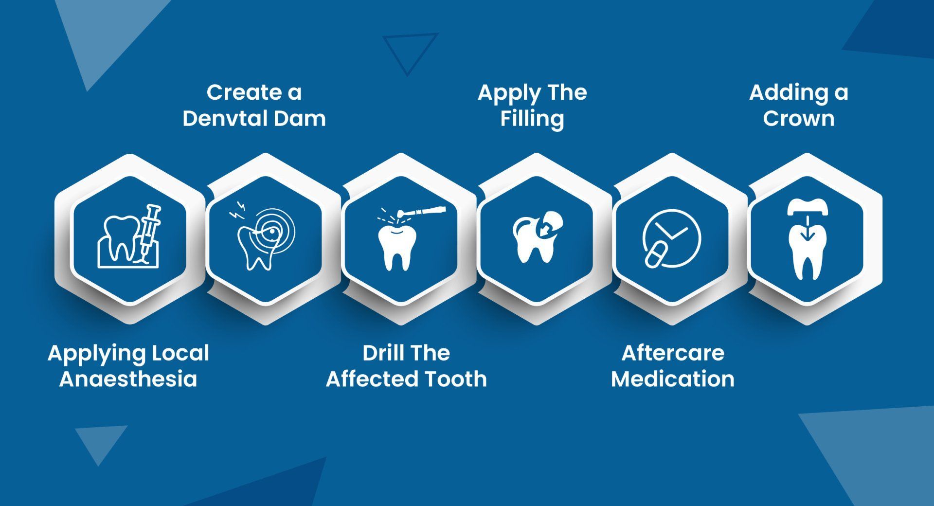 Steps Involved In Root Canal Treatment