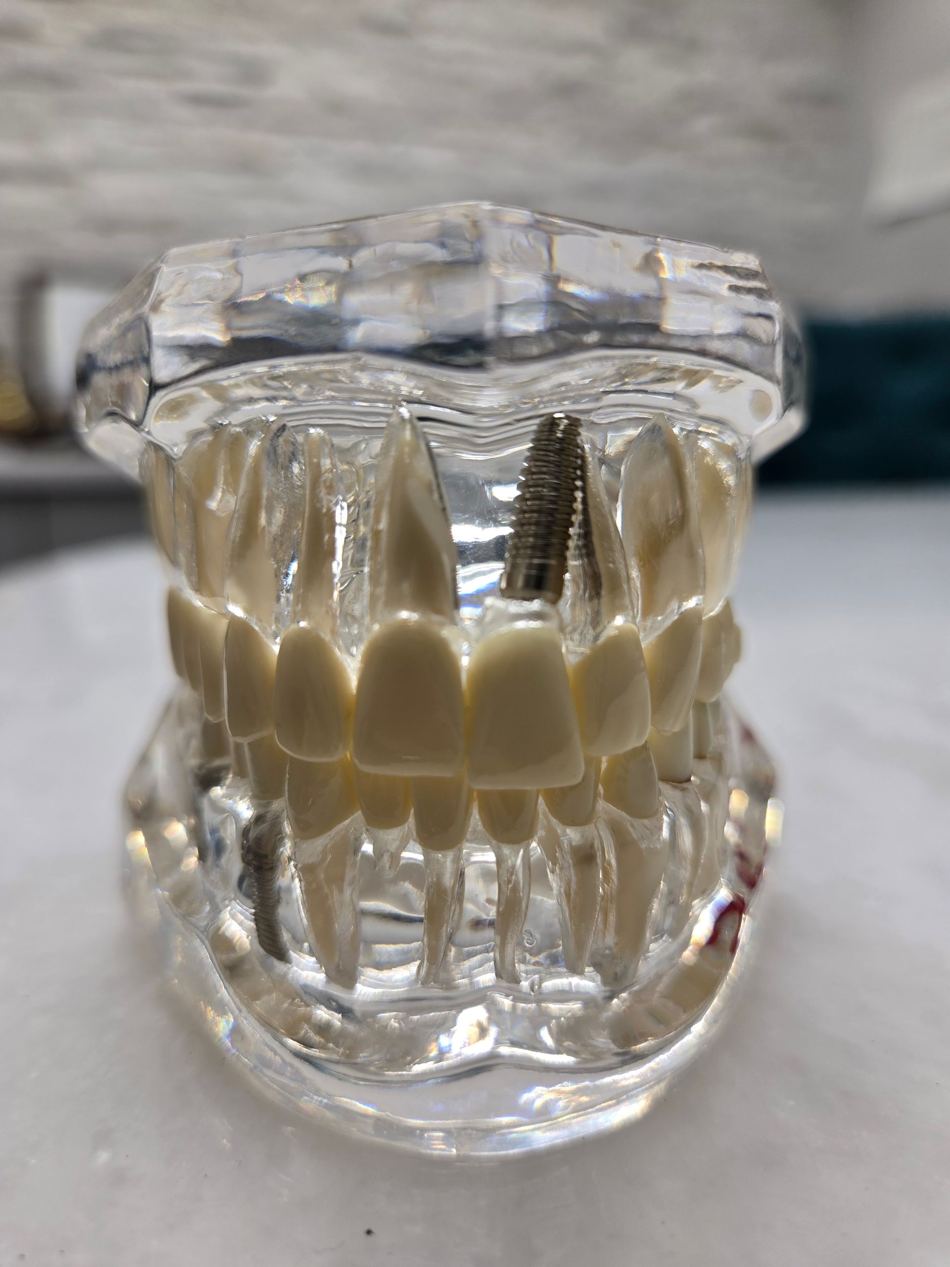 A clear dental model with a dental implant in it