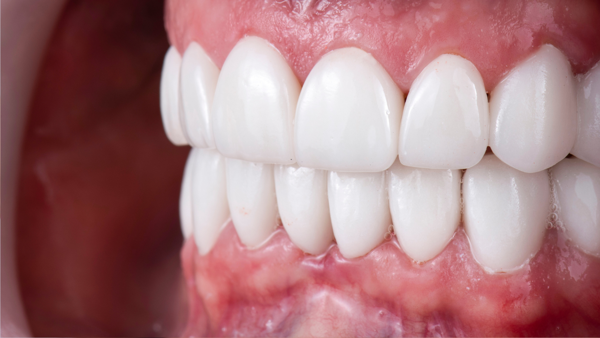 Close-up of white dentures fitted over pink gums in a mouth