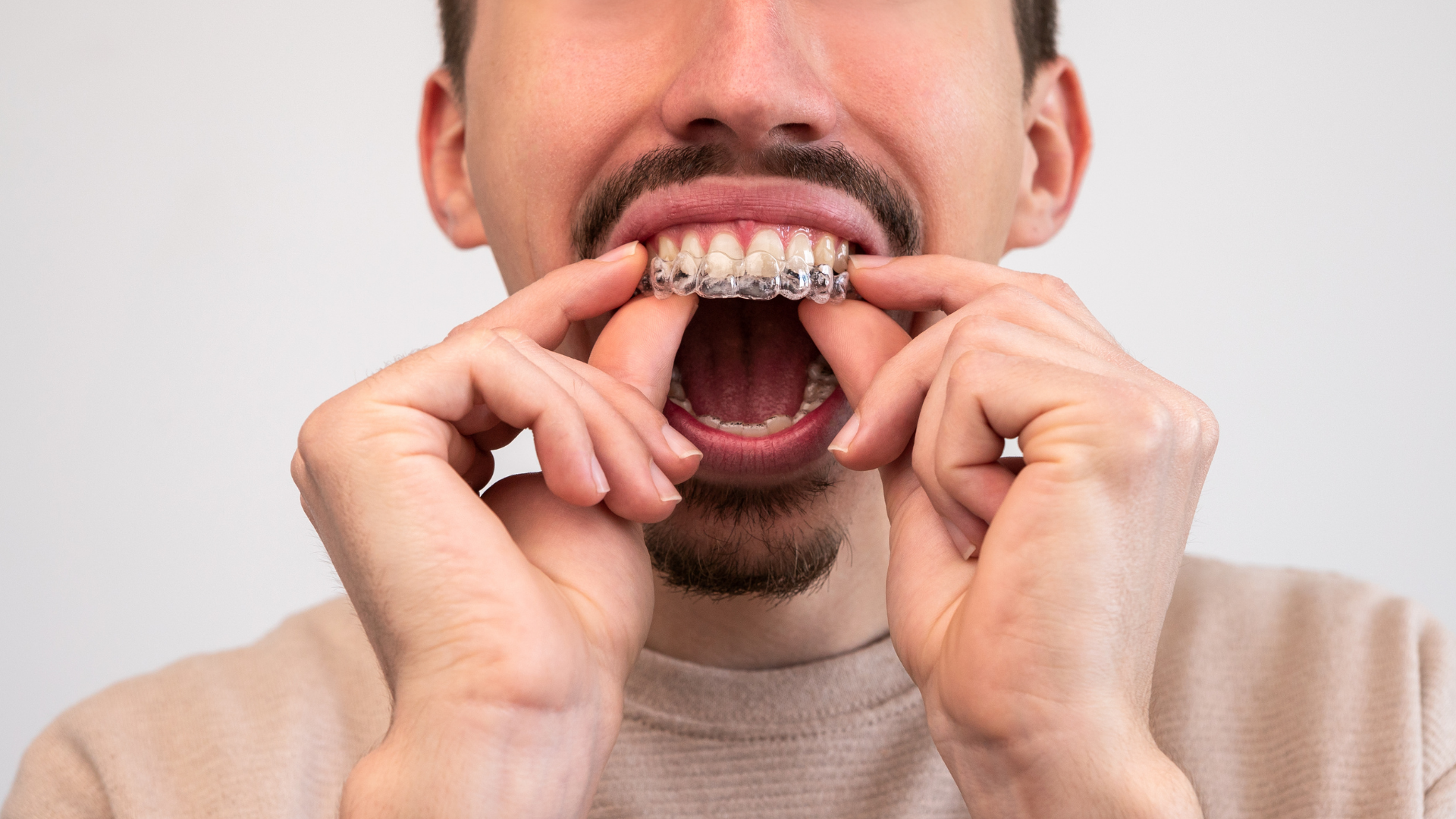 Man inserting clear aligner into teeth. Open mouth, beige shirt, white background.