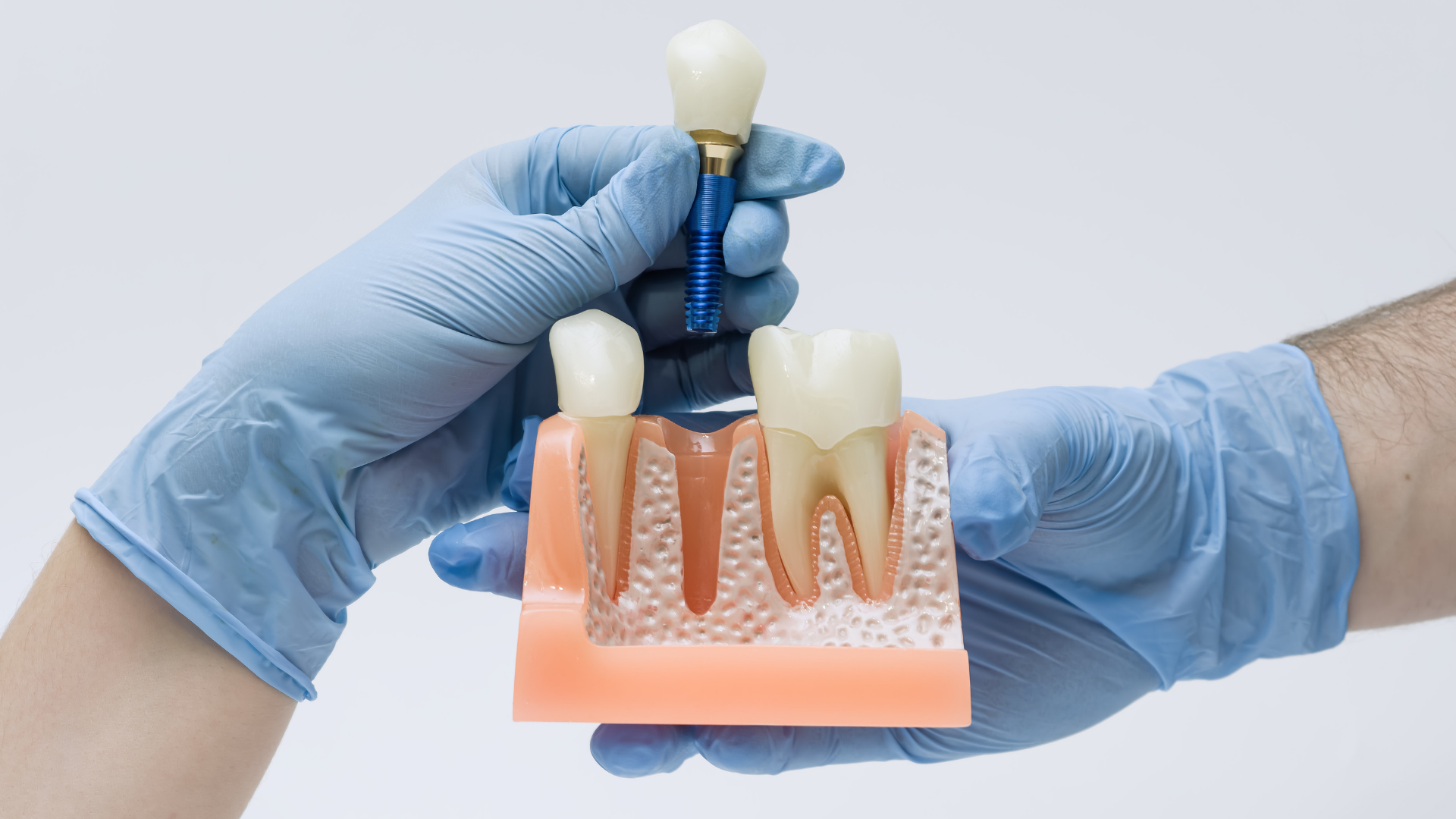 Gloved hands holding a dental implant model and blue implant tool against a white background