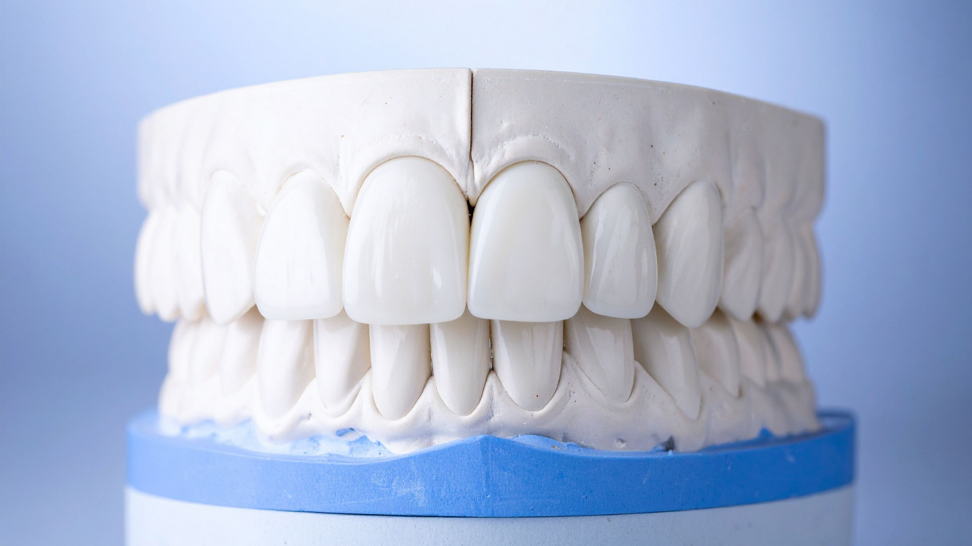 Dental model displaying upper and lower teeth, light blue backdrop.