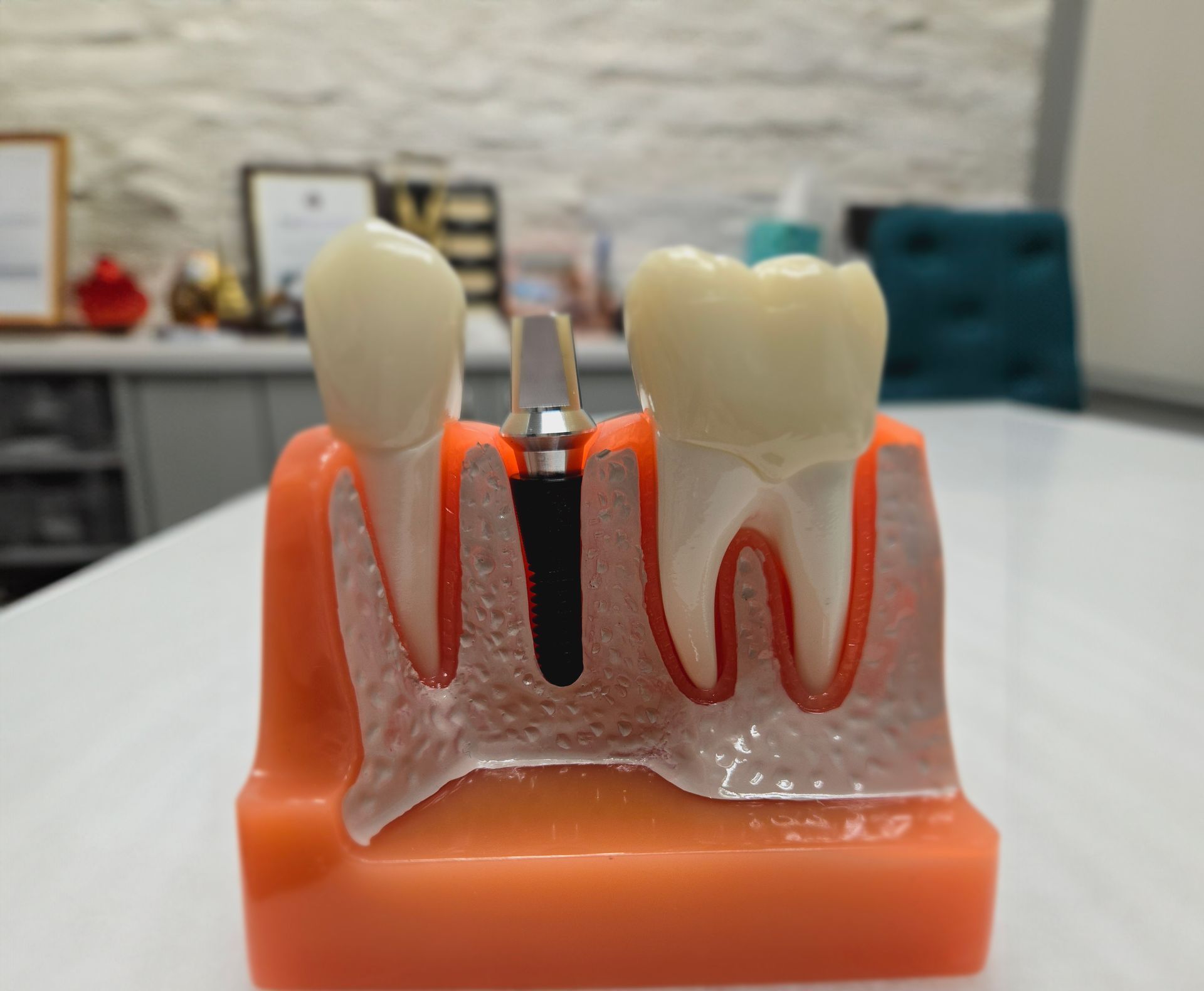 A model of a dental implant sitting on top of a table.