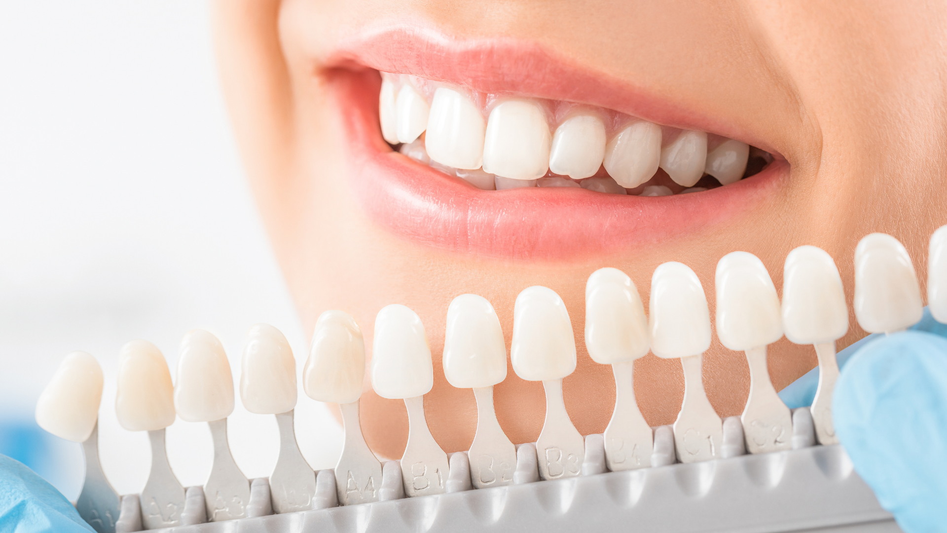 Dental veneers being held in a gloved hand beneath a smiling mouth with white teeth