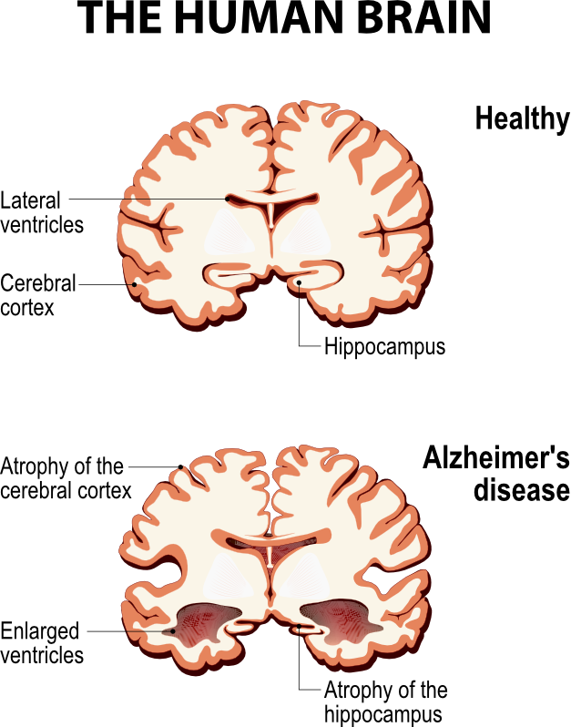 A diagram of the human brain showing atrophy of the cerebral cortex and alzheimer 's disease.