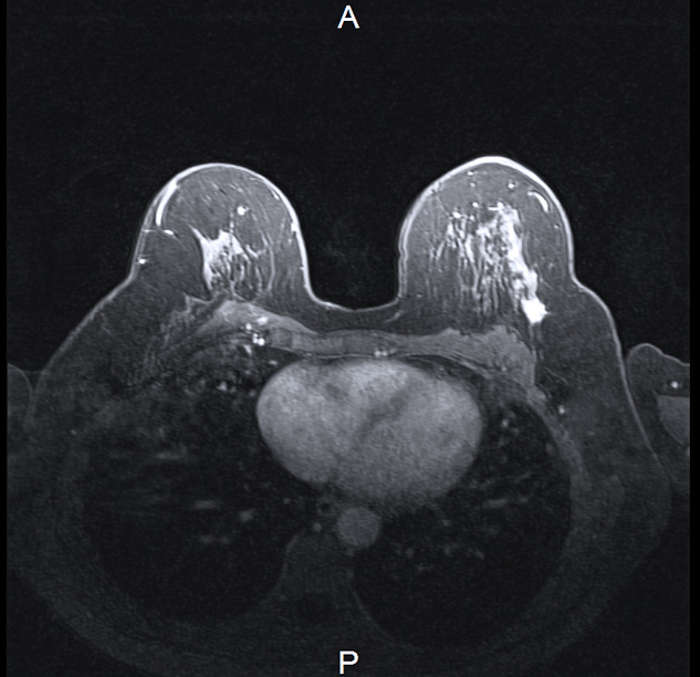 MRI