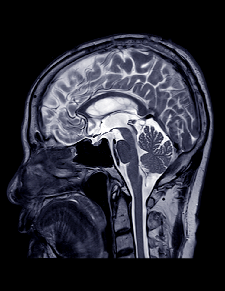 It is a mri of a human head showing the brain.