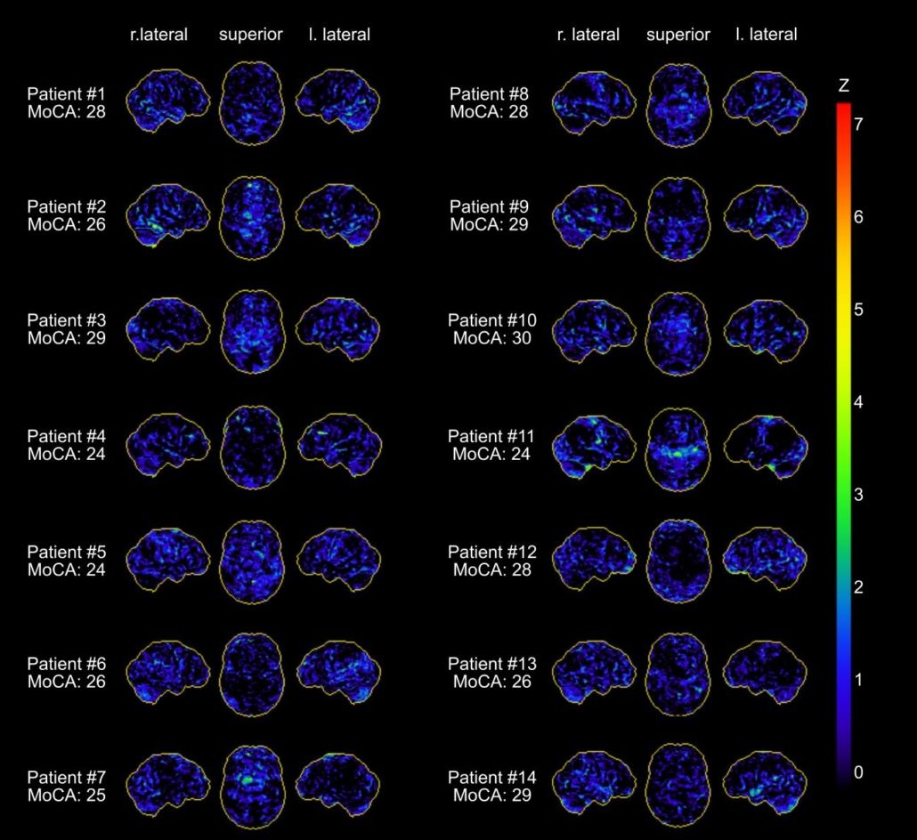 A computer generated image of a brain with a rainbow of colors