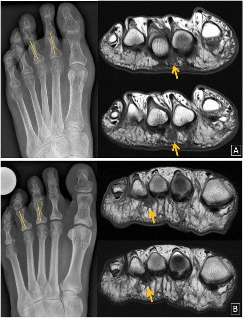 A pair of x-rays of a foot and a mri of a foot.