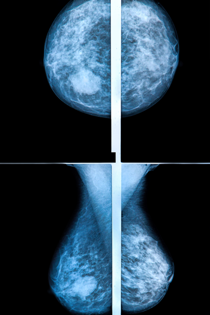 shutterstock_469619390 digital breast tomosynthesis