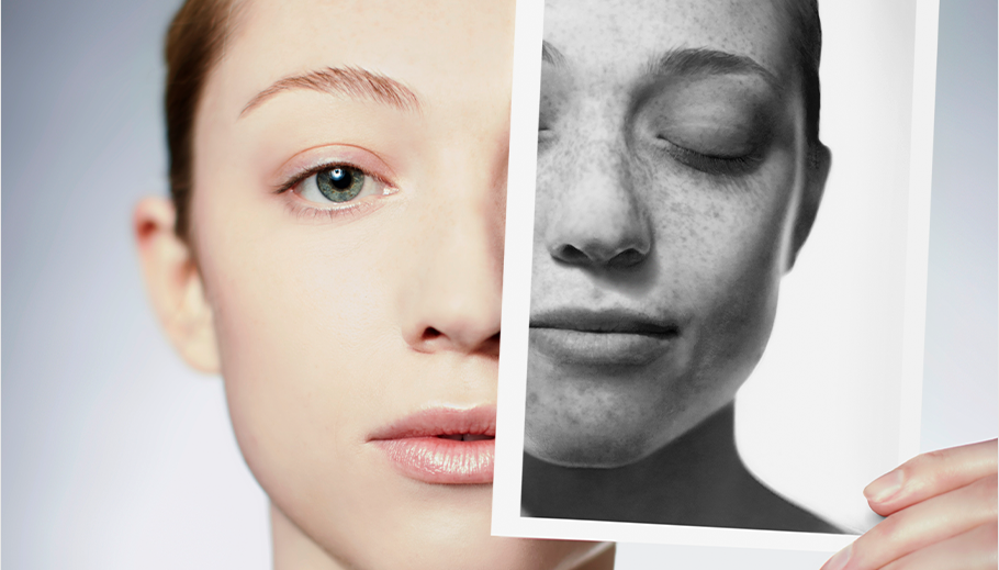 Facial Rejuvenation, Gangnam Seoul – Why does the face age in layers?