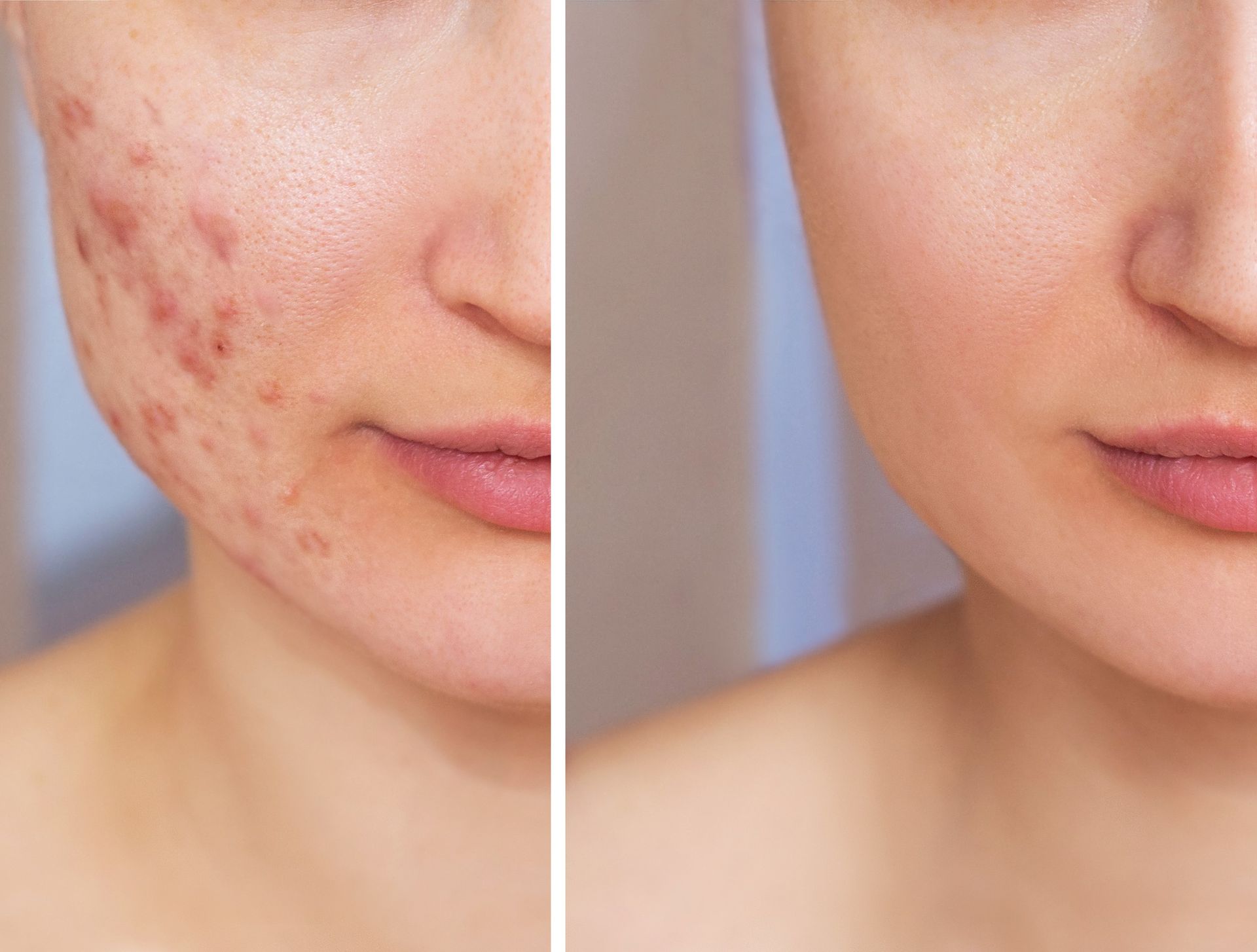 A before and after photo of a woman 's face with acne.