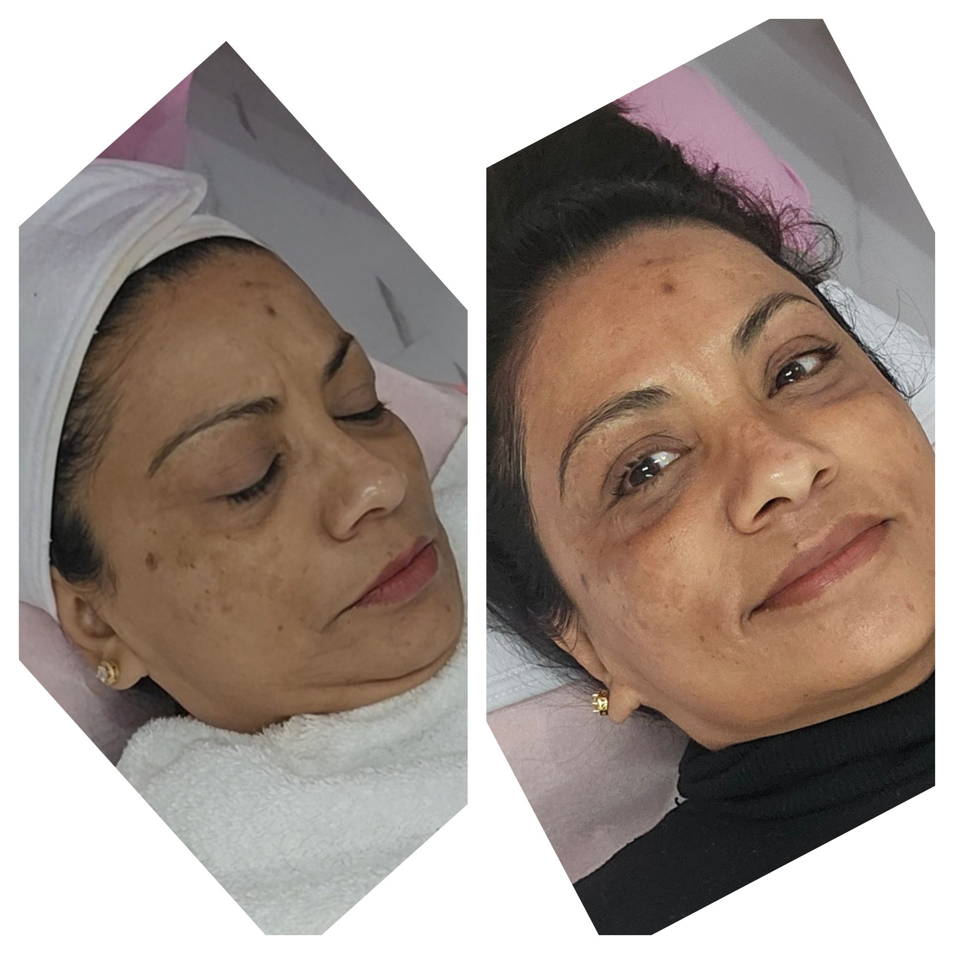 A before and after picture of a woman 's face