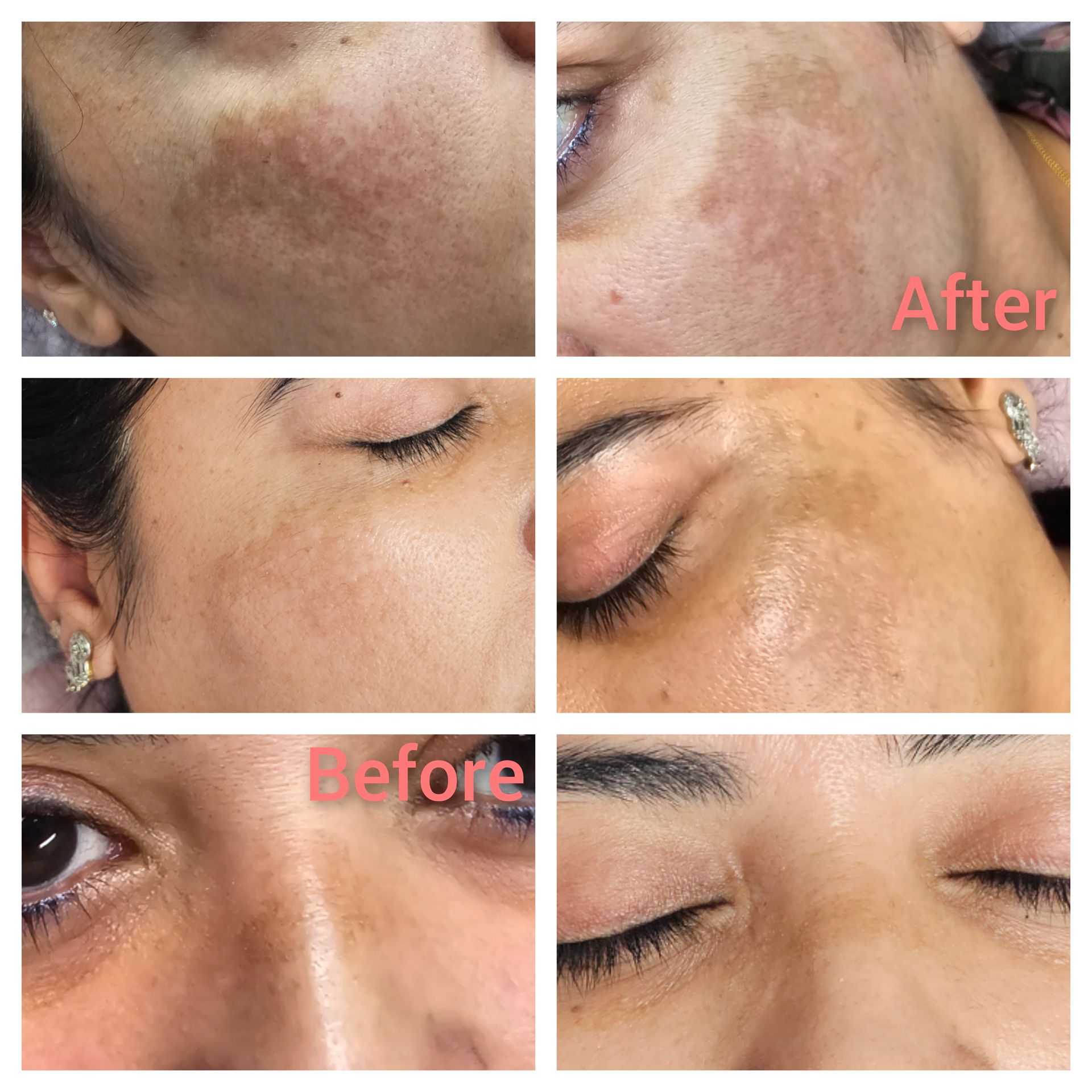 A collage of before and after photos of a woman 's face.