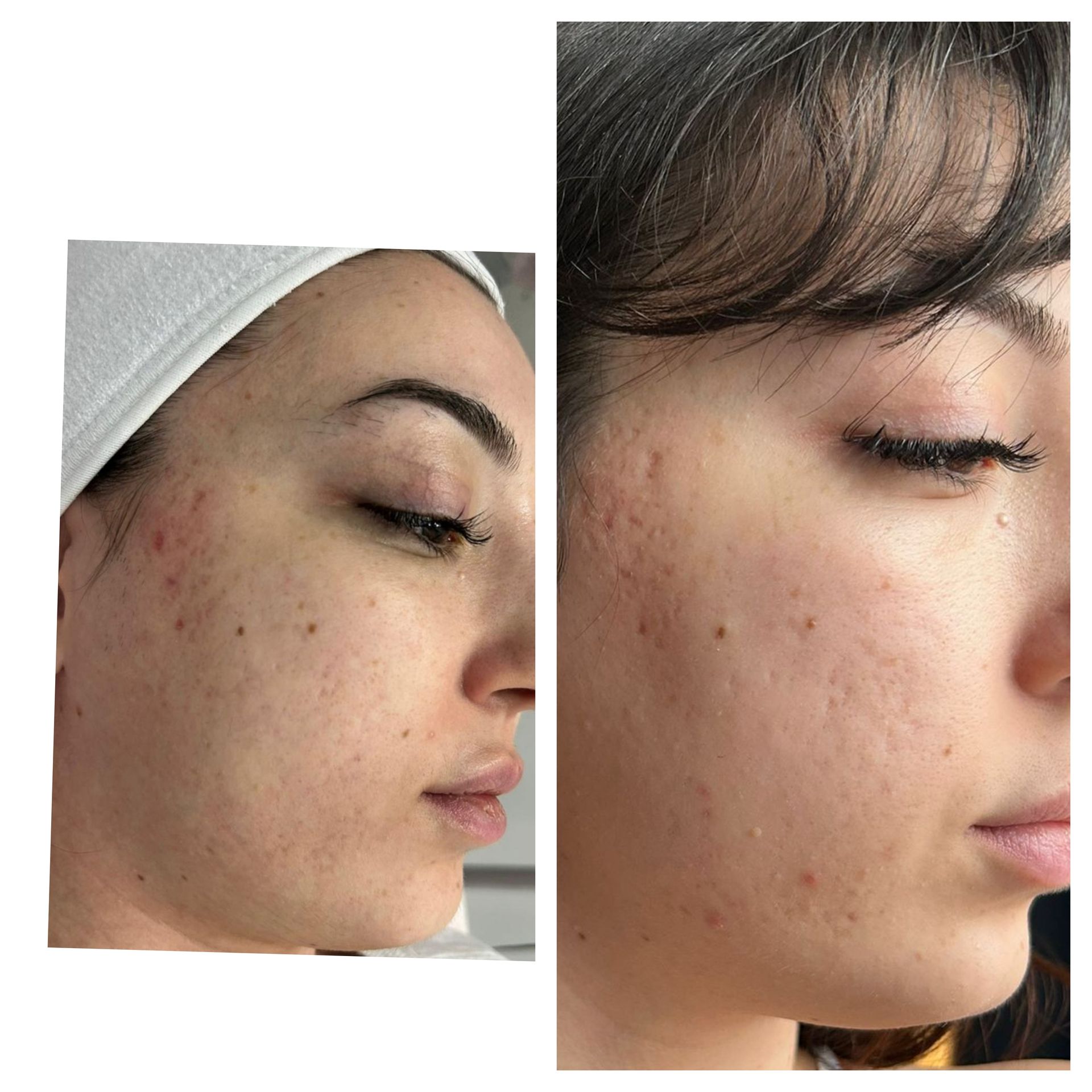 A before and after photo of a woman 's face with acne.
