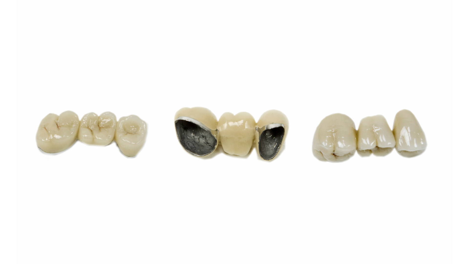 Top Benefits of Same Day Crowns for San Diego Residents
