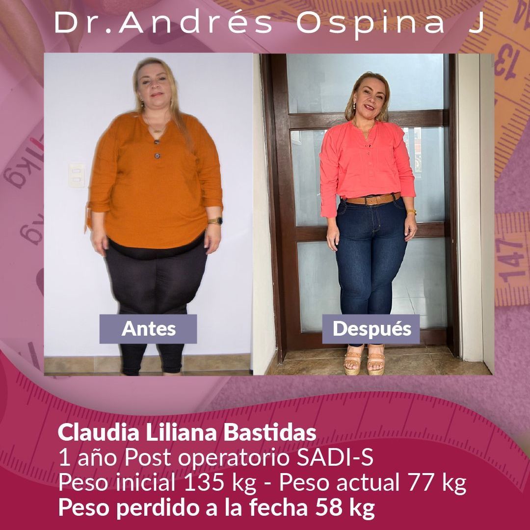 Una foto de una mujer antes y después de perder peso.