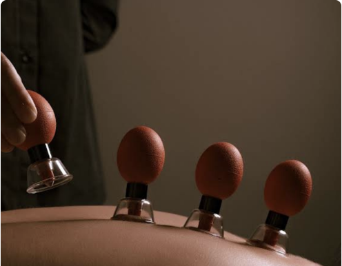 Cupping Therapy