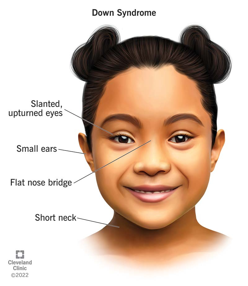 Symbolisches Portrait eines Down Syndrom Kindes