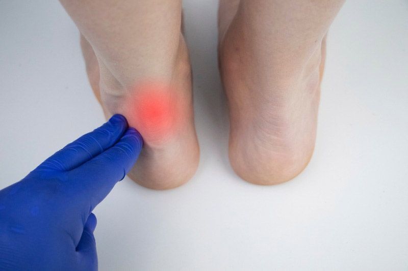 Achilles tendonitis causing heel pain treated with physiotherapy and rehabilitation