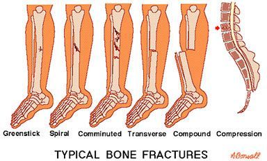 Types of bone fractures including greenstick, spiral, transverse, and compression