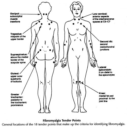 Fibromyalgia tender points diagram used in physiotherapy assessment Mississauga