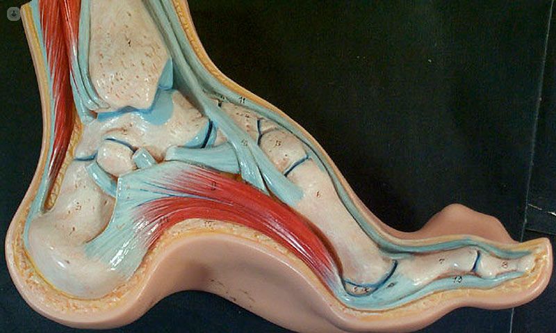High arch foot structure causing pain and imbalance treated with physiotherapy
