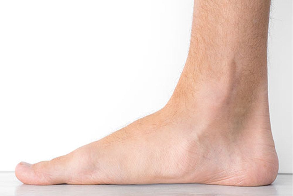 Flat feet condition affecting foot alignment treated with physiotherapy and orthotics