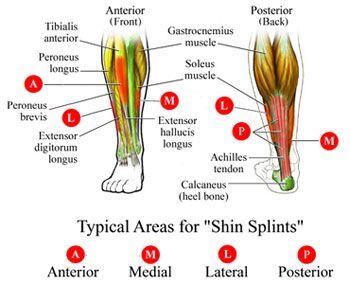 Diagram of shin splint pain areas on the lower leg.
