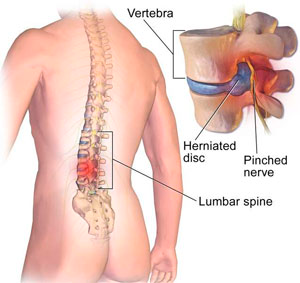Herniated disc and pinched nerve causing back pain and nerve compression