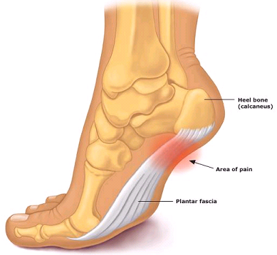 Plantar fasciitis treatment in Mississauga physiotherapy clinic