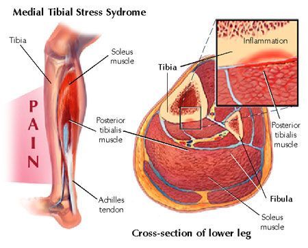 Medial tibial stress syndrome diagram with shin inflammation