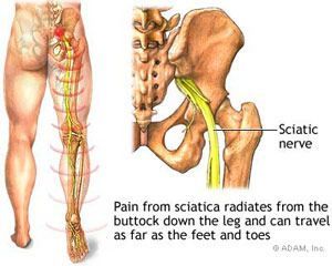 Piriformis syndrome affecting the sciatic nerve causing hip and leg pain treated with physiotherapy