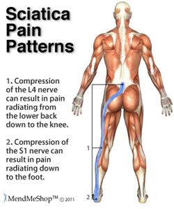 Sciatica nerve pain treatment in Mississauga physiotherapy clinic
