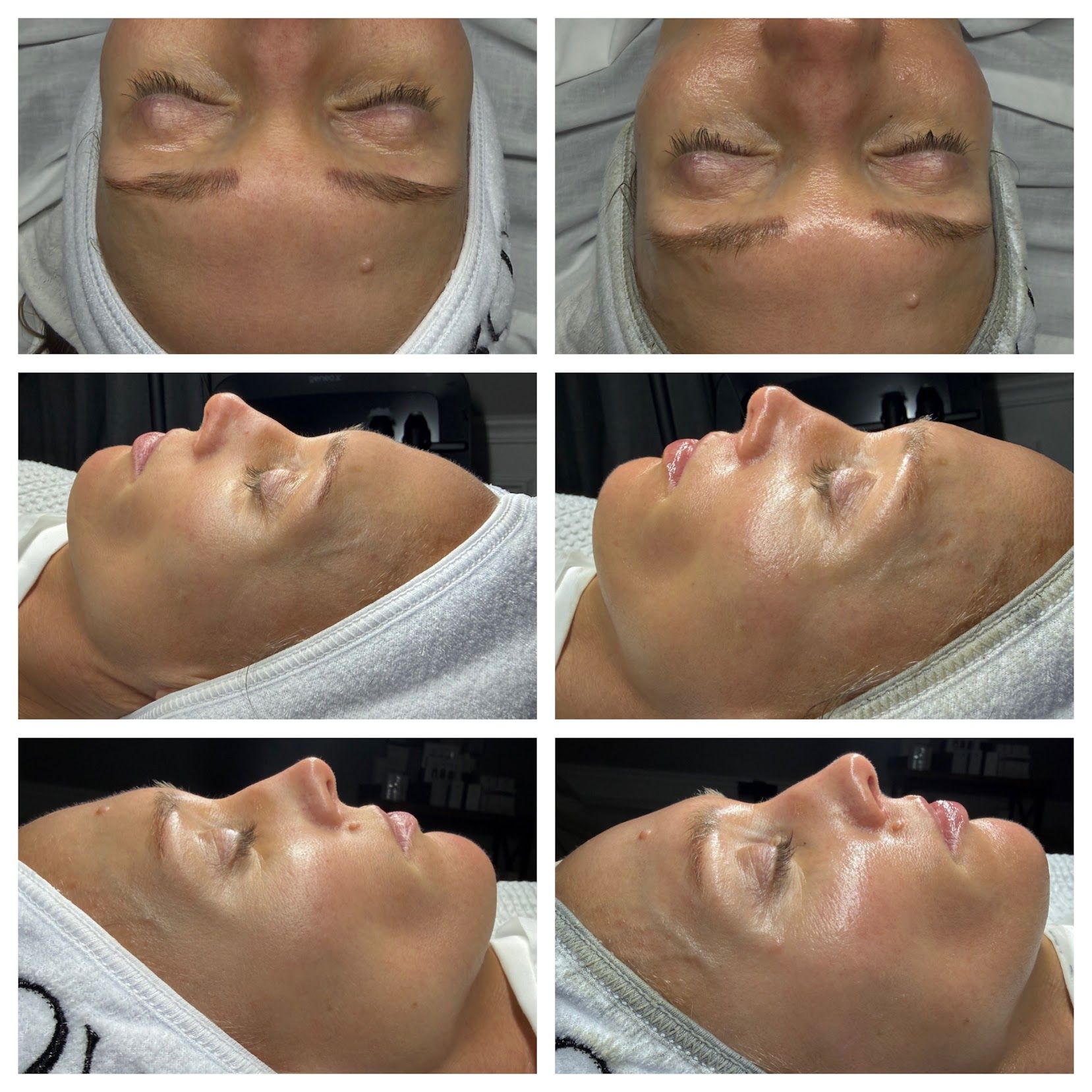Collage of a face in close-up before-and-after side views, showing a shiny skincare or facial treatment process