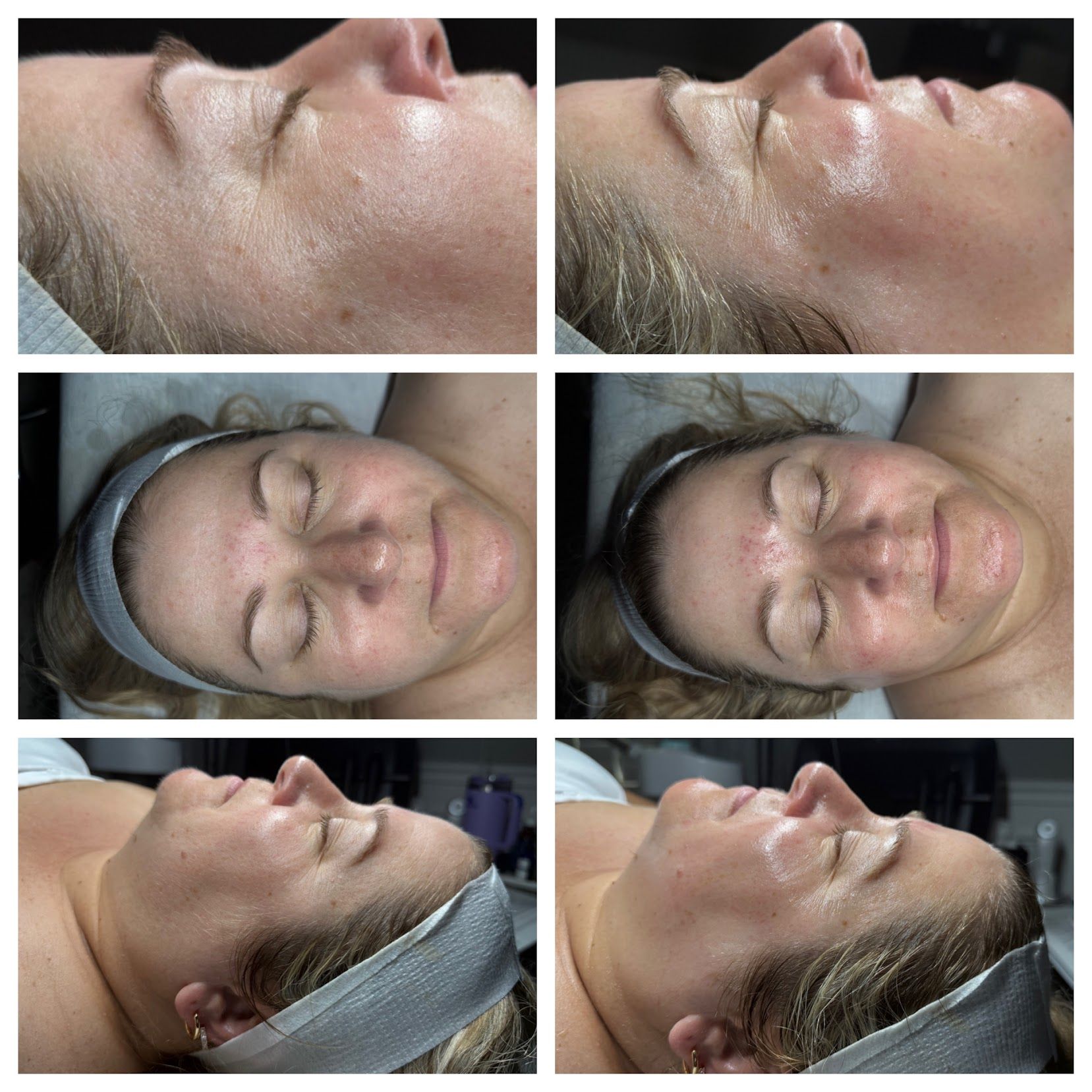 Collage of facial close-ups showing a woman receiving a skincare treatment with cream on her face